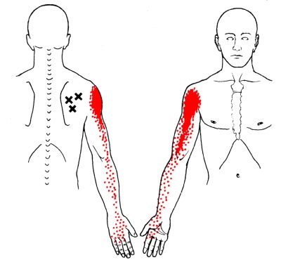 bol u zglobu ramena prilikom podizanja ruku u stranu